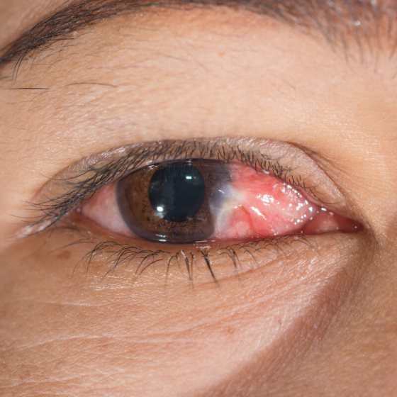 inflamed eye with the eye condition Pterygium